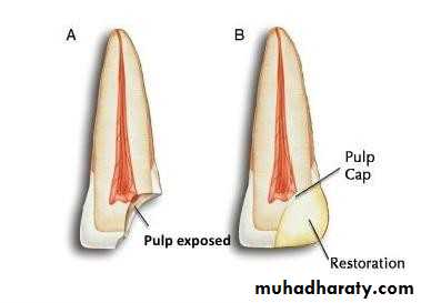 Treatment of deep seated caries