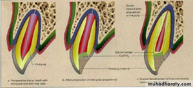 Treatment of deep seated caries