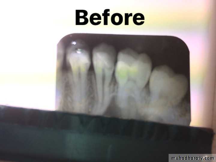 Treatment of deep seated caries