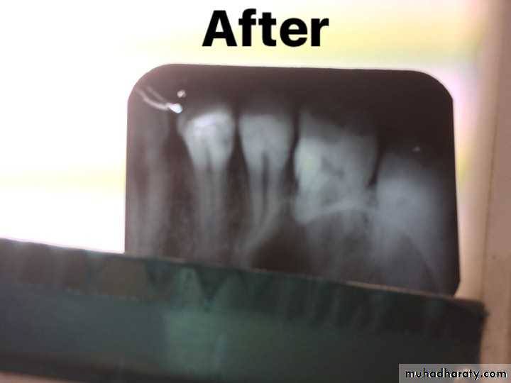 Treatment of deep seated caries