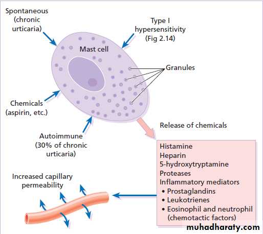 urticaria ppt
