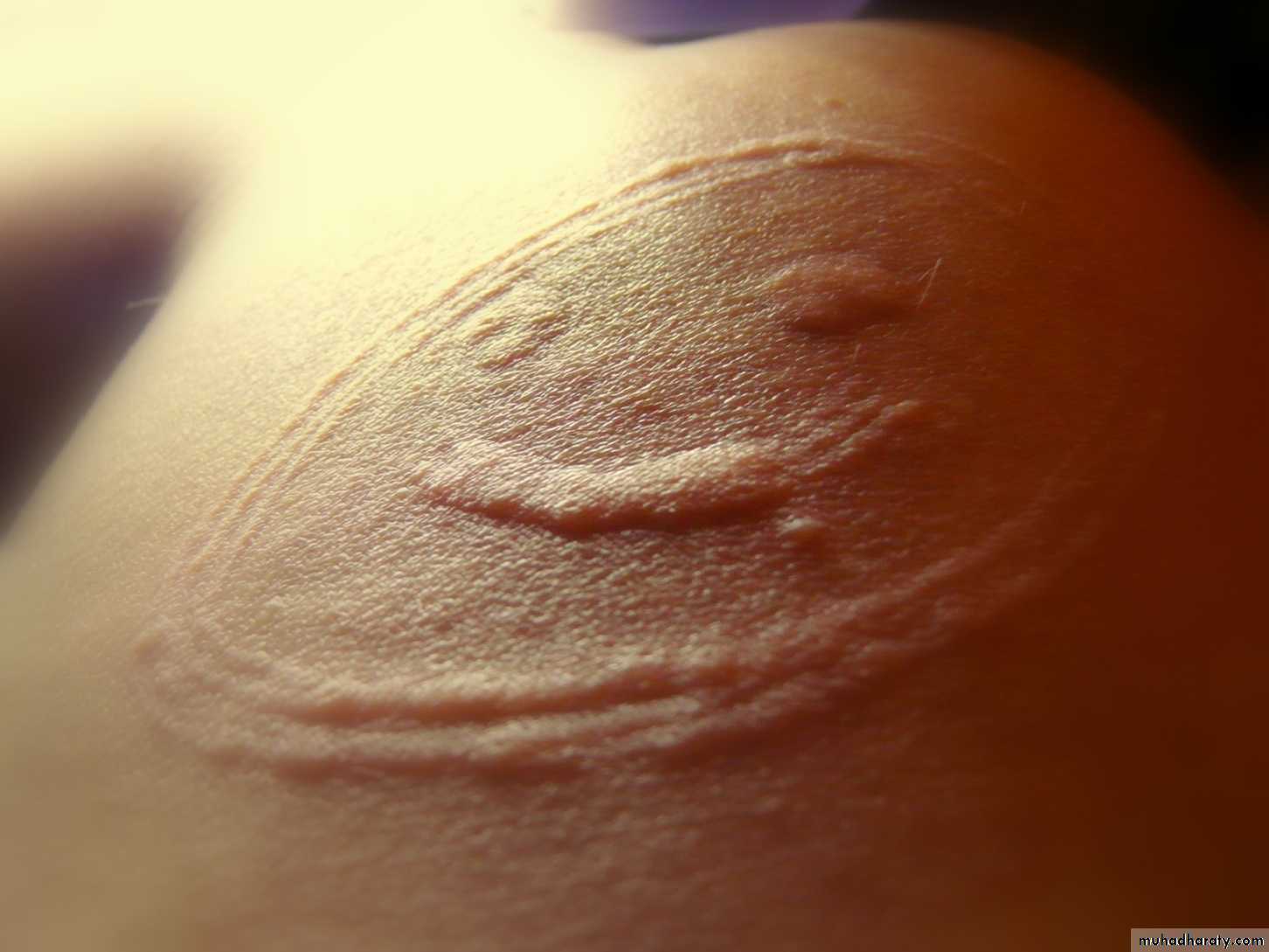 urticaria ppt