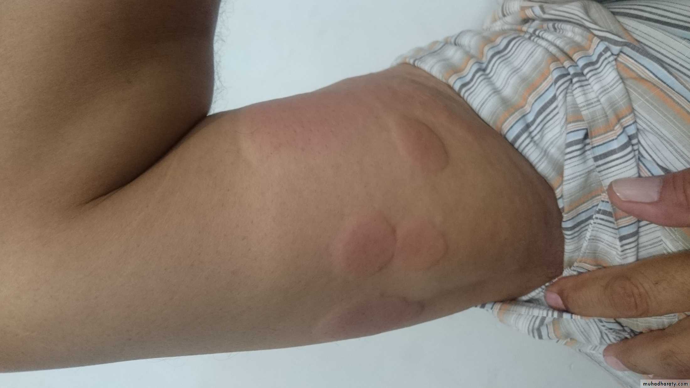 urticaria ppt