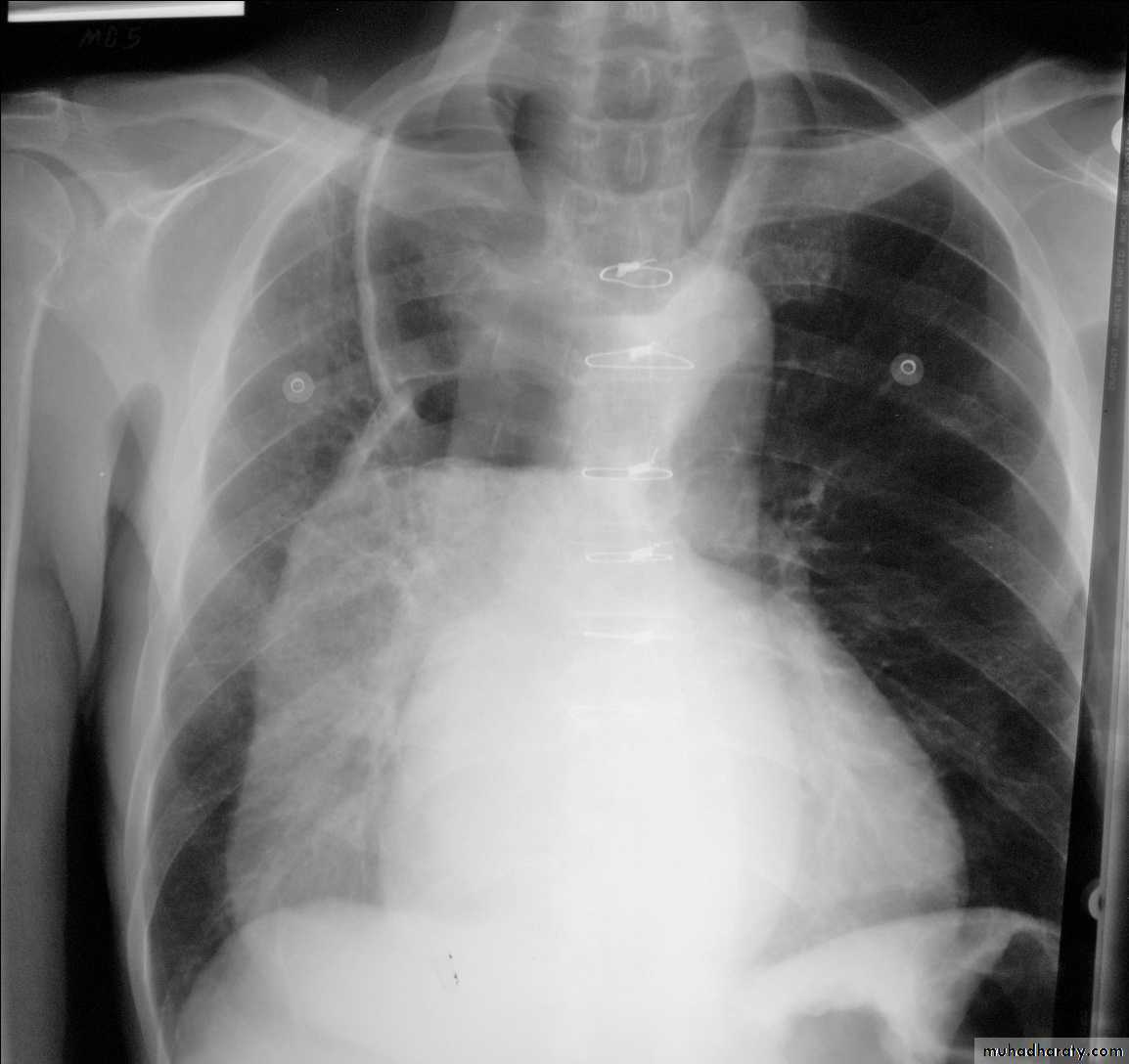 Esophagus