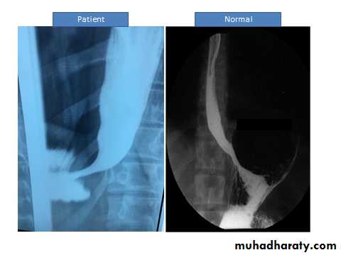 Esophagus