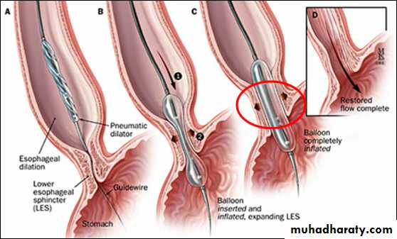 Esophagus