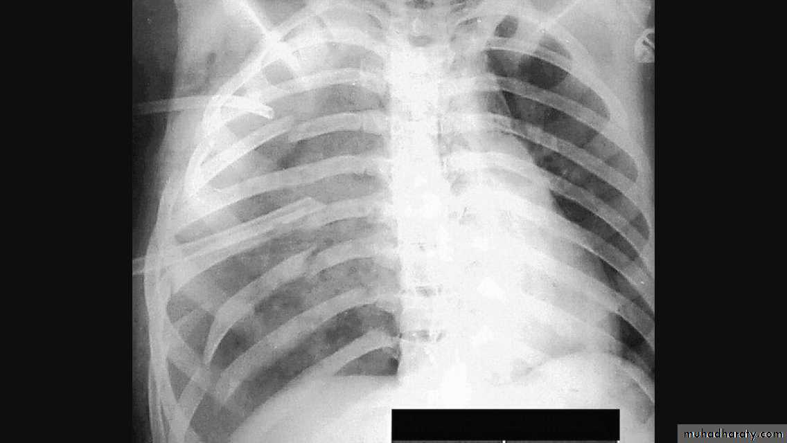 Chest investigations