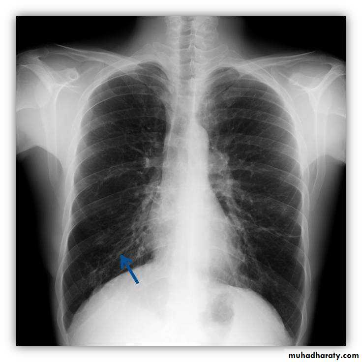 Chest investigations