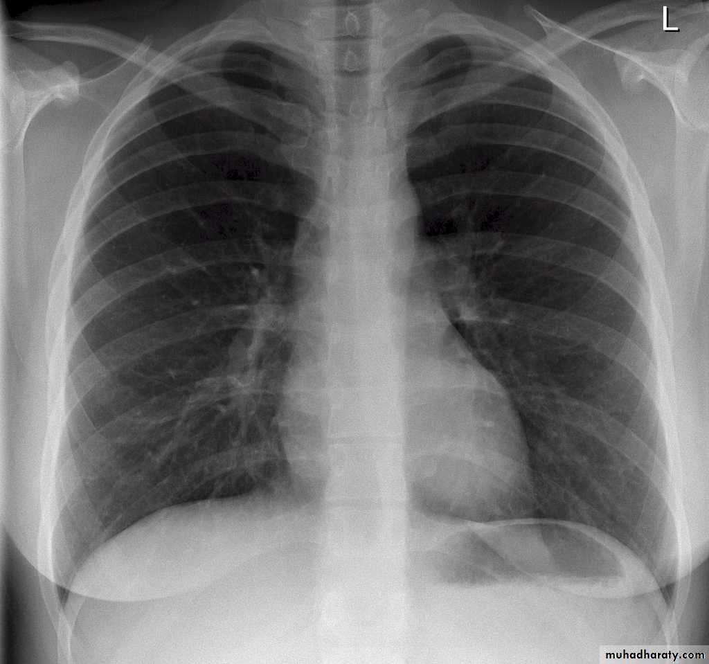 Chest investigations