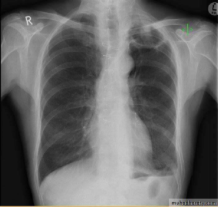 Chest investigations