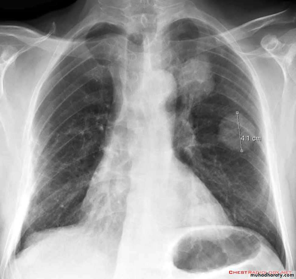 Chest investigations