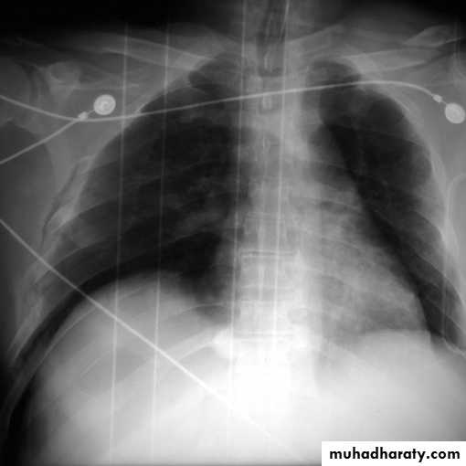 Chest investigations