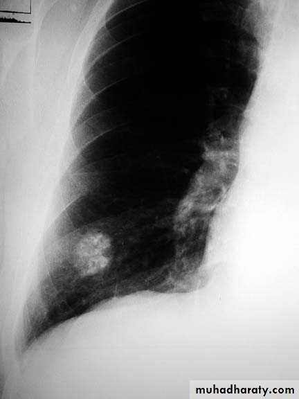 Chest investigations