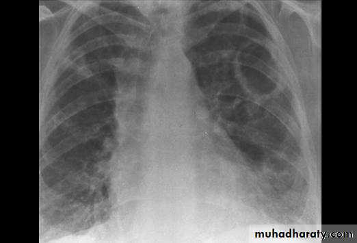 Chest investigations