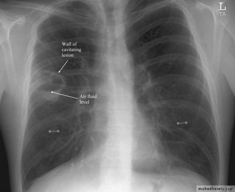 Chest investigations