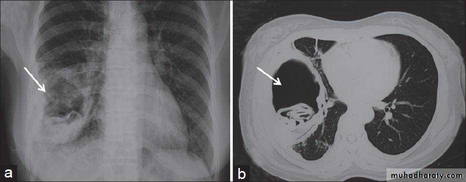 Chest investigations