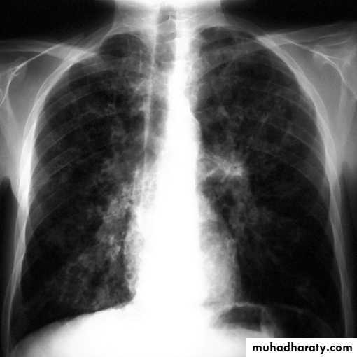 Chest investigations