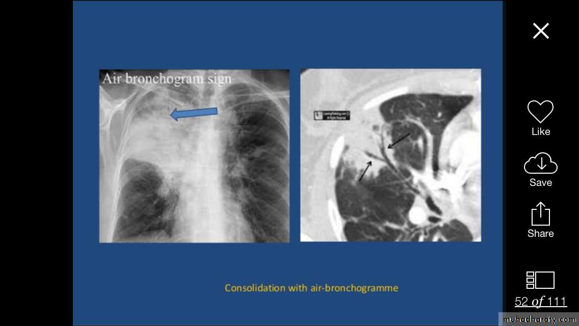 Chest investigations