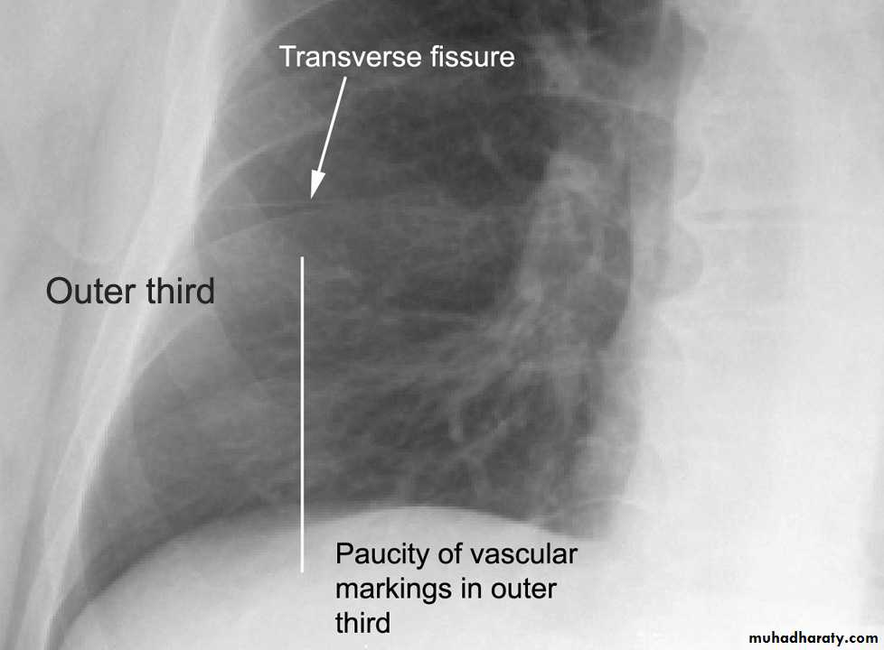 Chest investigations