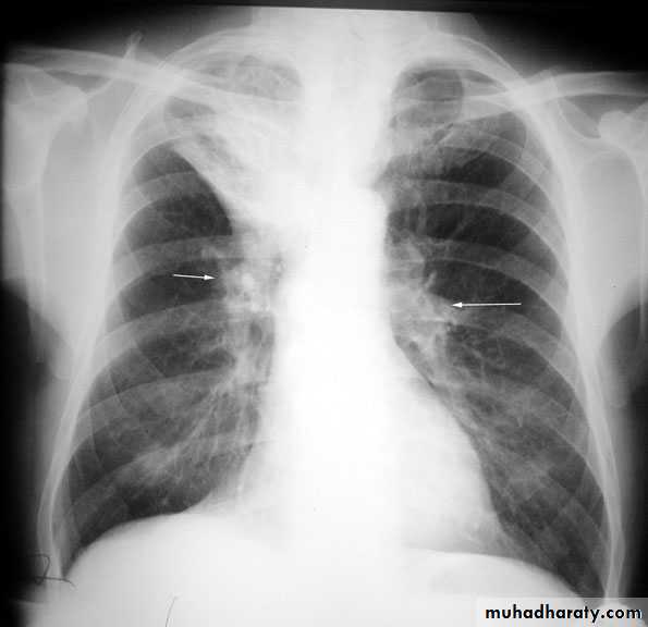 Chest investigations
