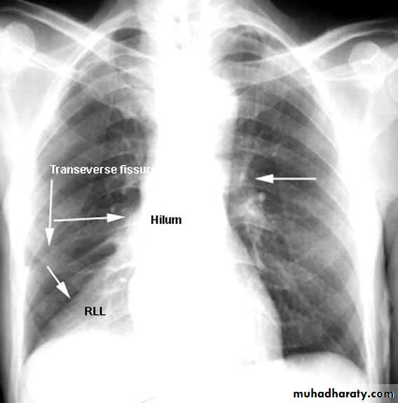 Chest investigations