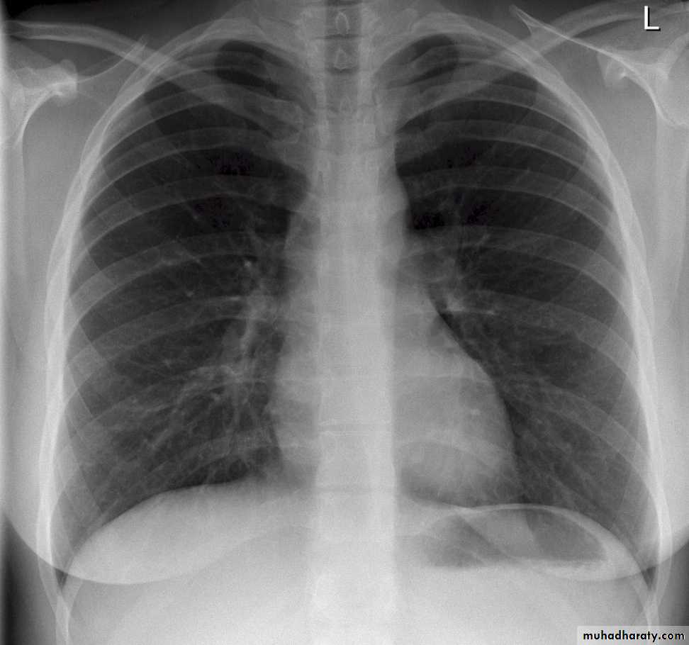 Chest investigations