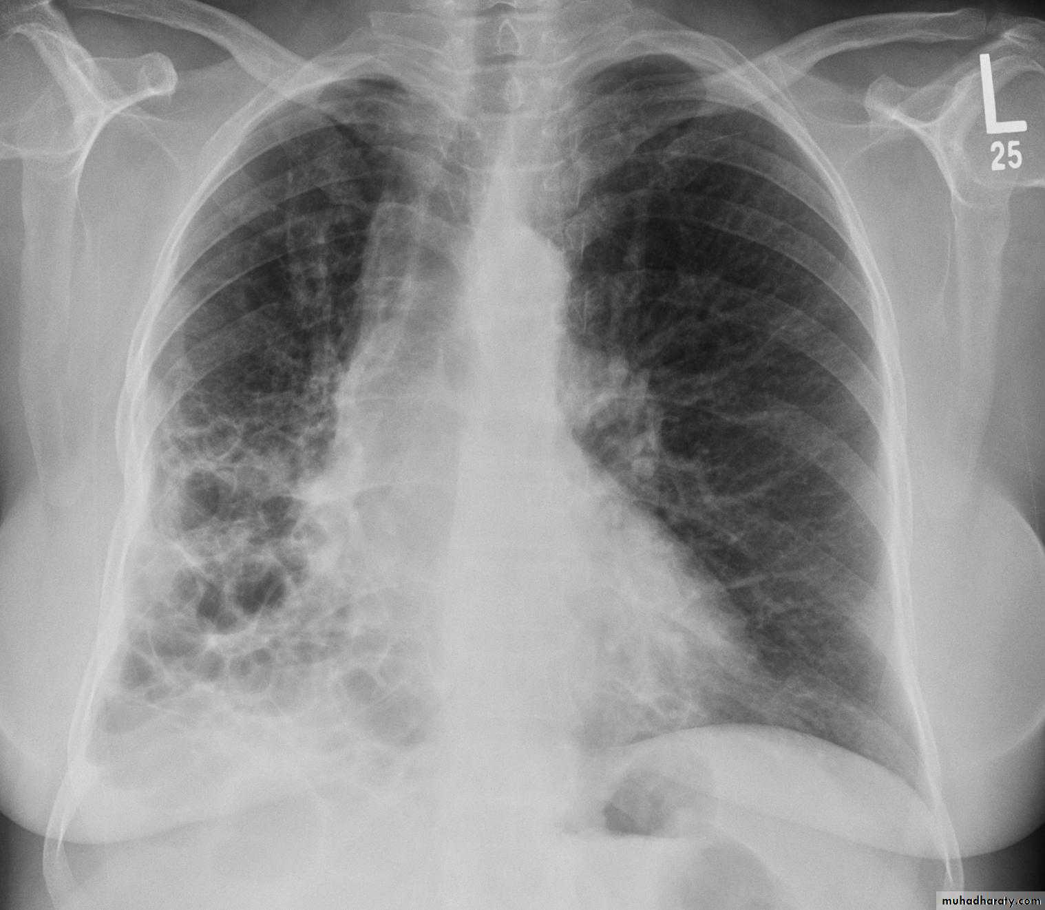 Chest investigations