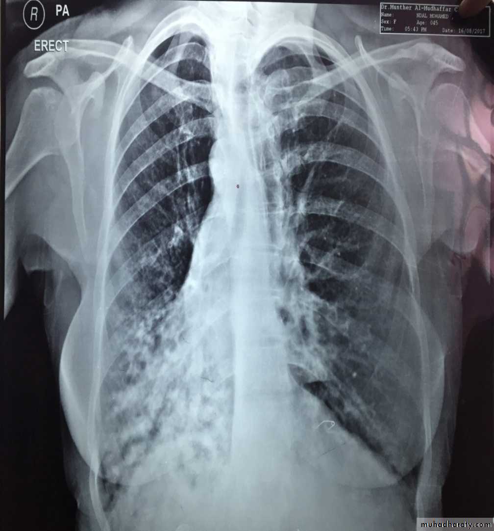 Chest investigations