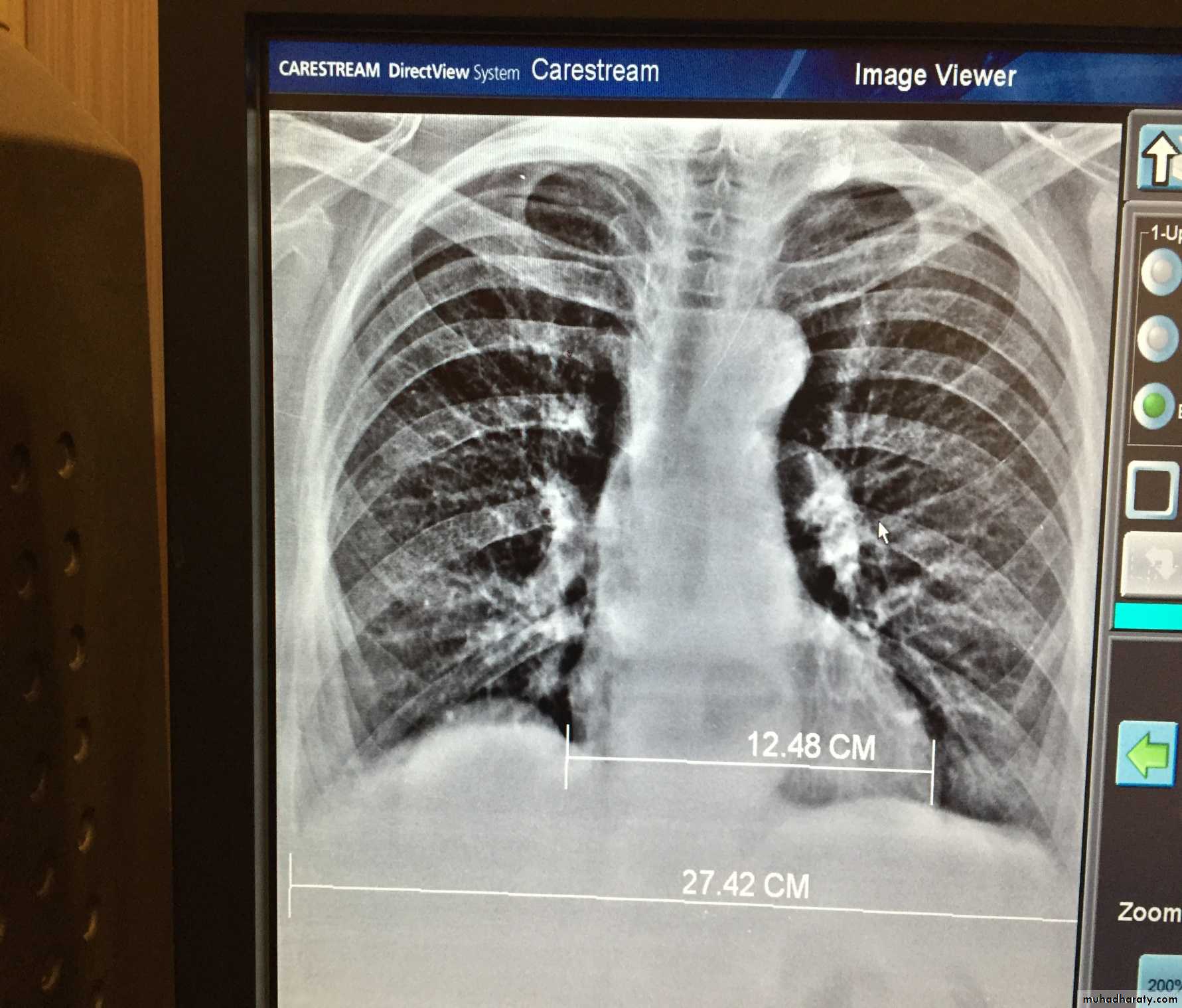 Chest investigations