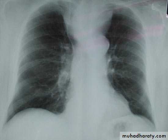 Chest investigations