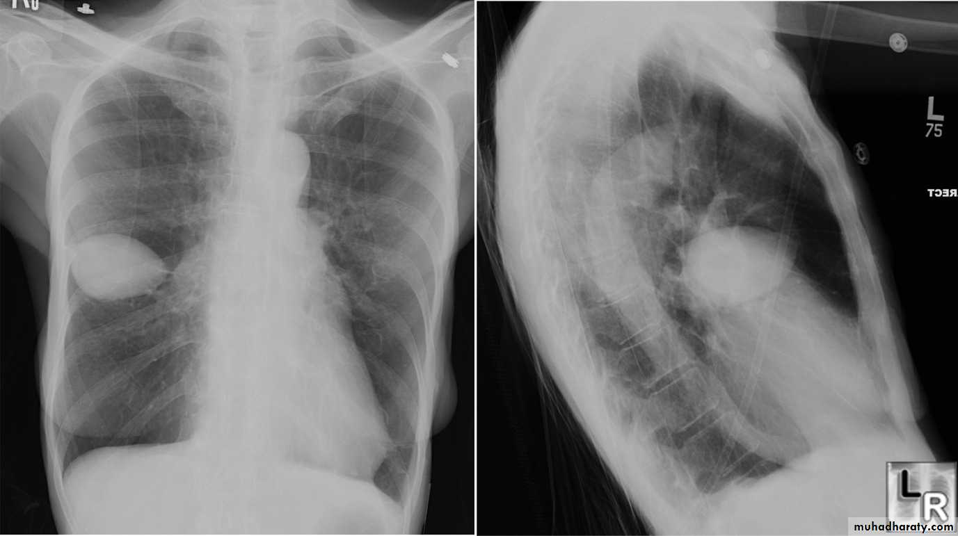 Chest investigations