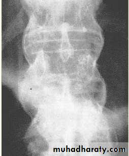 Spondyloarthropathies