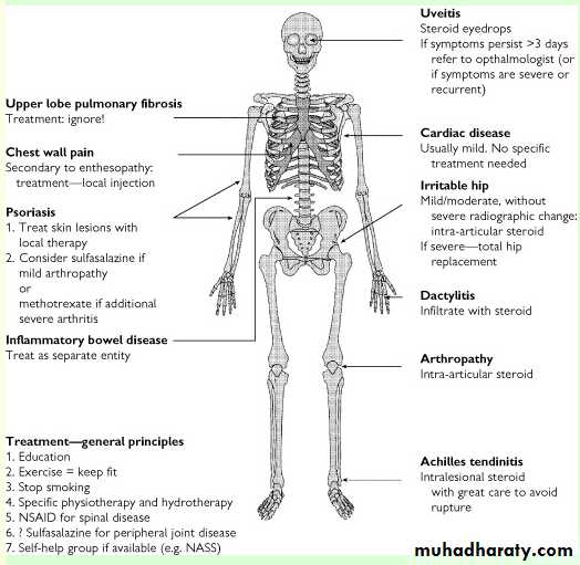 Spondyloarthropathies