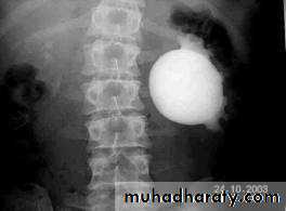 Ureteropelvic Junction Obstruction