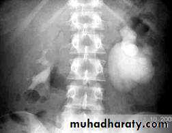Ureteropelvic Junction Obstruction