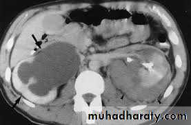 Ureteropelvic Junction Obstruction