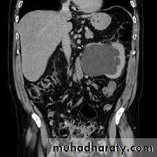 Ureteropelvic Junction Obstruction