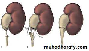 Ureteropelvic Junction Obstruction