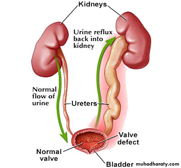 Ureteropelvic Junction Obstruction