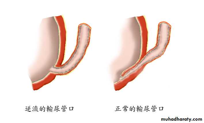 Ureteropelvic Junction Obstruction