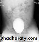 Ureteropelvic Junction Obstruction