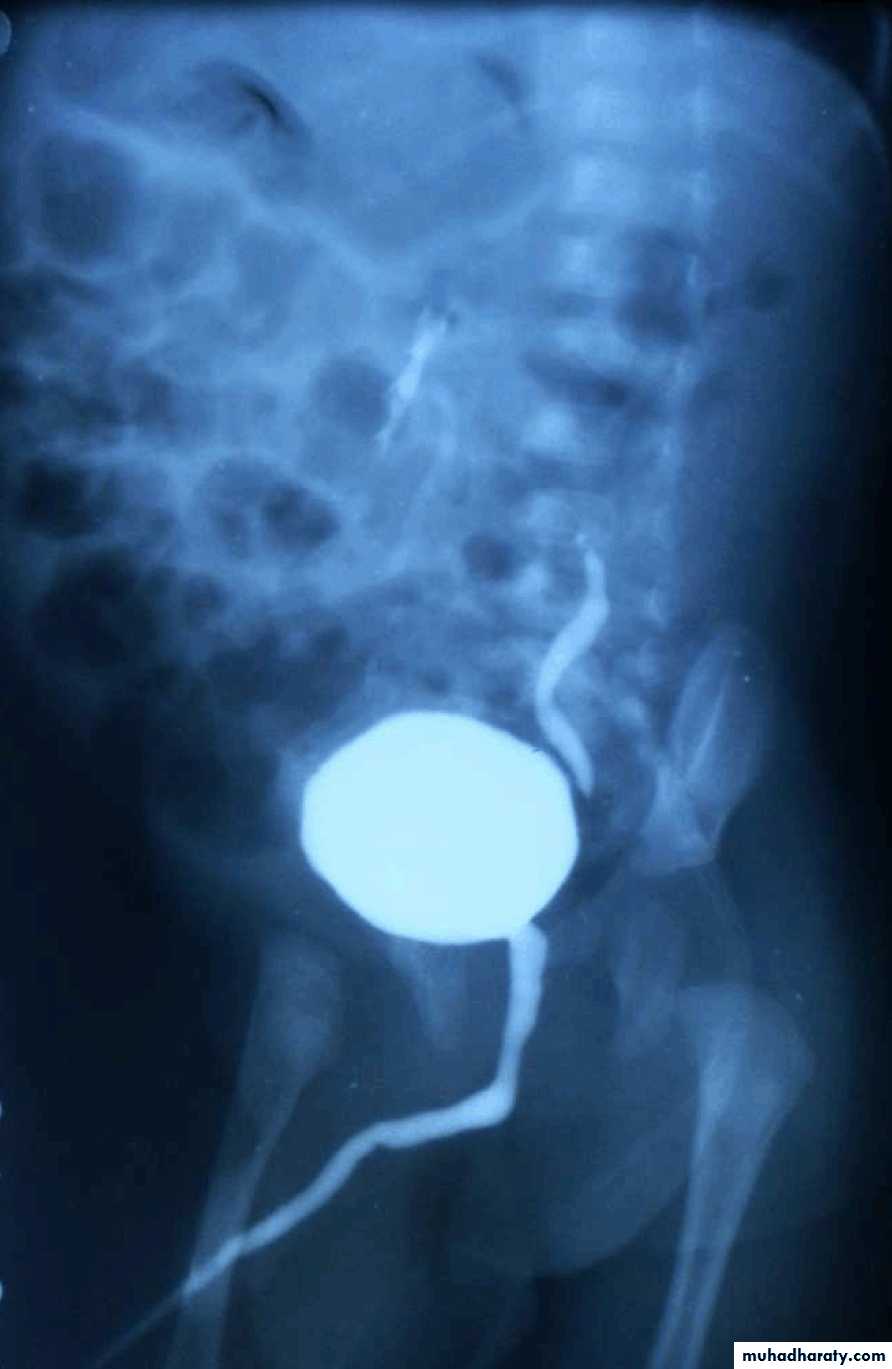 Ureteropelvic Junction Obstruction