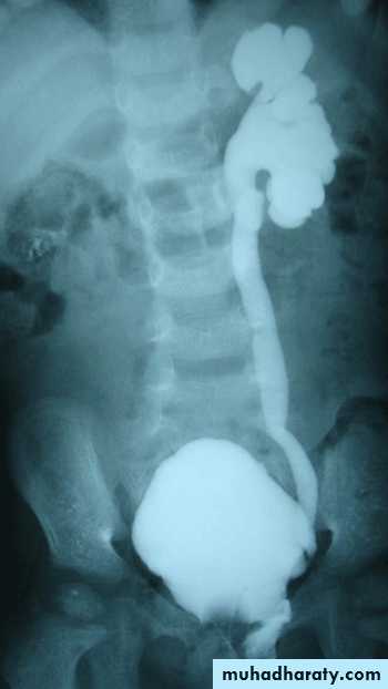 Ureteropelvic Junction Obstruction
