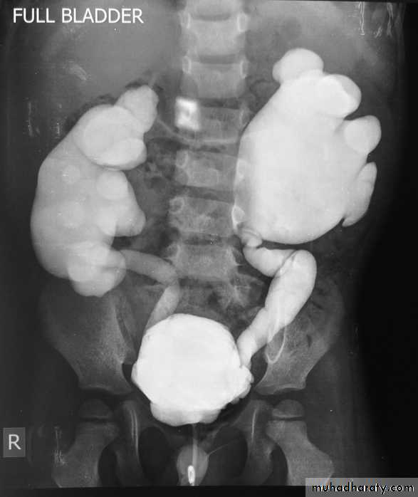 Ureteropelvic Junction Obstruction
