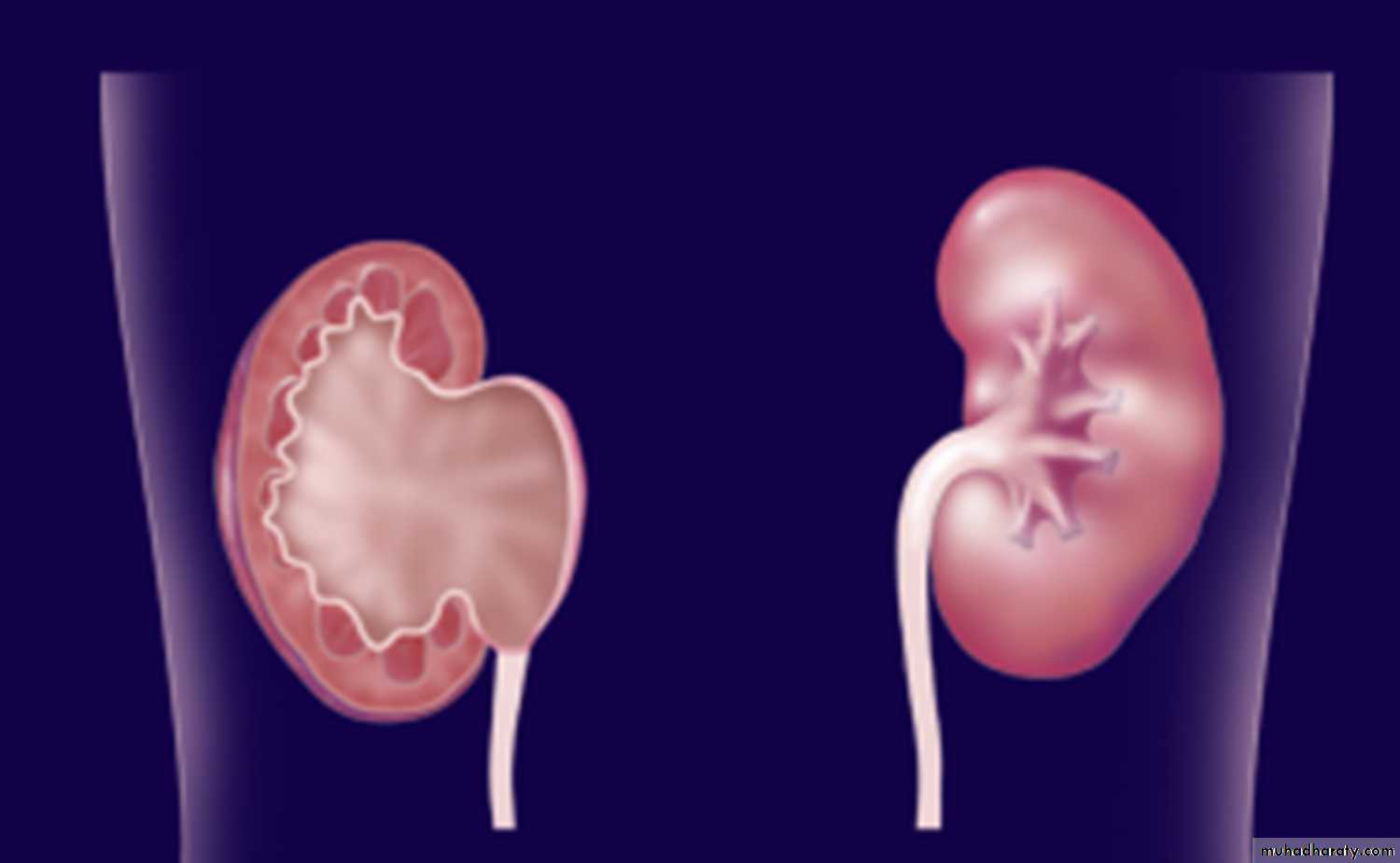 Ureteropelvic Junction Obstruction