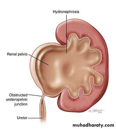 Ureteropelvic Junction Obstruction