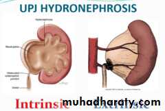 Ureteropelvic Junction Obstruction