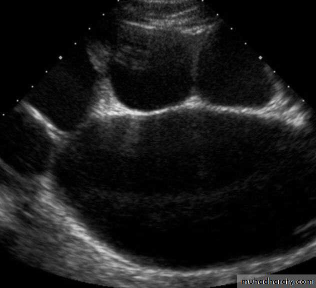 Ureteropelvic Junction Obstruction