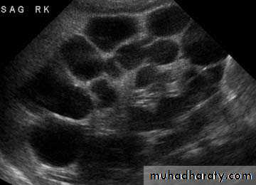 Ureteropelvic Junction Obstruction