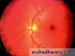 Hypertension